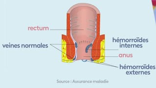 Santé  Tout sur les hémorroïdes [upl. by Uchida]