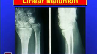 Distal Radius Fractures [upl. by Annyl]