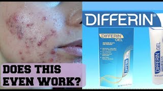 I TRIED DIFFERIN GEL FOR ONE WEEK AND THIS IS THE RESULTS  Review on Adapalene Gel [upl. by Ayhtak978]