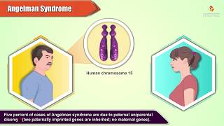 Angelman Syndrome  Pathology and Genetics [upl. by Larrad]