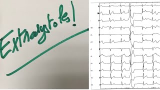 Extrasystoles ablation pour tous [upl. by Olmstead]